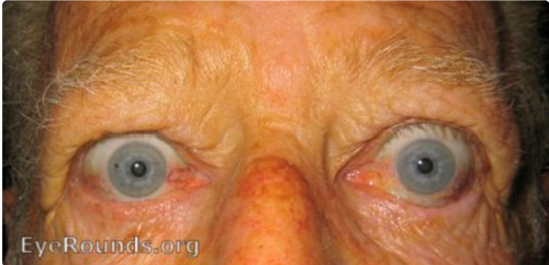 Patient with protruding eyes due to thyroid eye disease (TED)